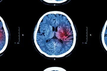 Some coronavirus patients may suffer from ‘micro-strokes’ that are too small to notice