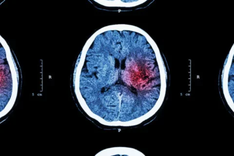 Some coronavirus patients may suffer from ‘micro-strokes’ that are too small to notice
