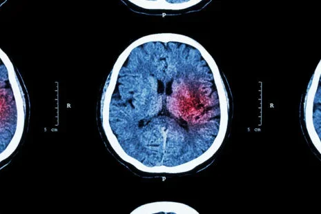 Some coronavirus patients may suffer from ‘micro-strokes’ that are too small to notice