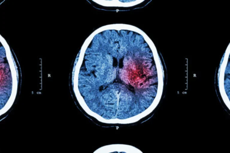 Some coronavirus patients may suffer from ‘micro-strokes’ that are too small to notice