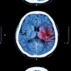 Some coronavirus patients may suffer from ‘micro-strokes’ that are too small to notice